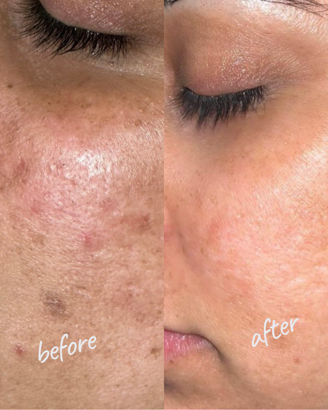 Carbon Laser Peeling NYC — Before and After